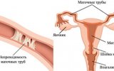Можно ли забеременеть с перевязанными маточными трубами 