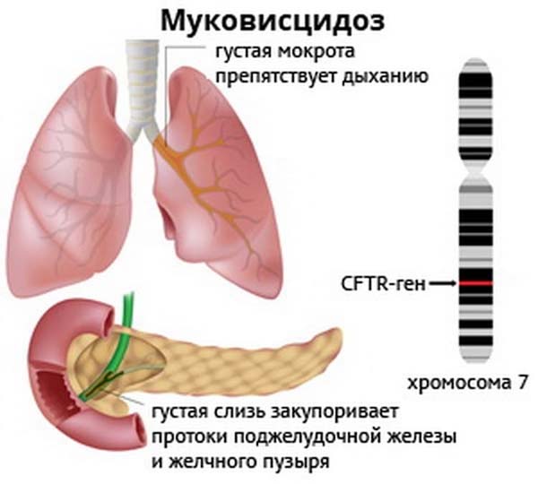 Муковисцидоз у детей 