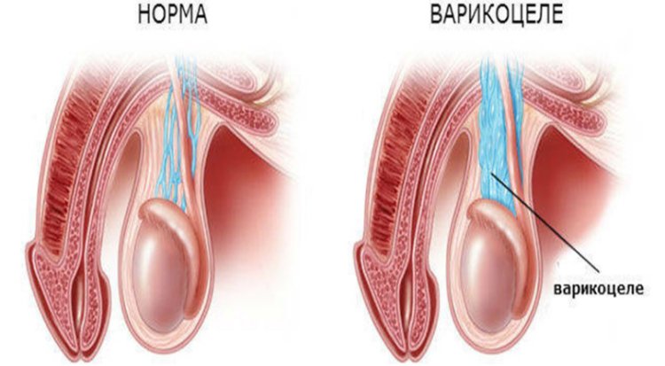 Варикоцеле 