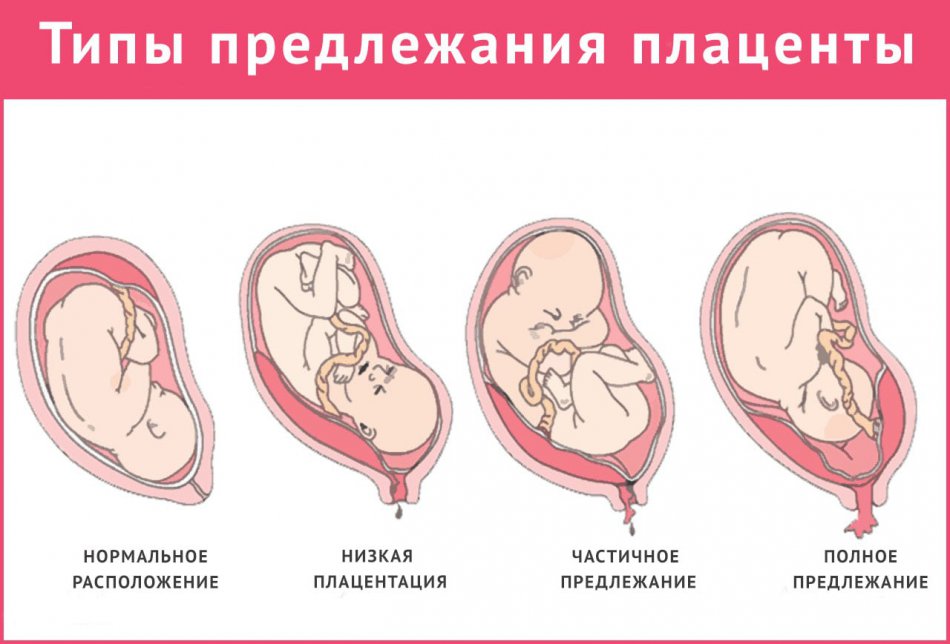 В чем опасность переднего расположения плаценты — диагностика и причины такого состояния + возможные осложнения 