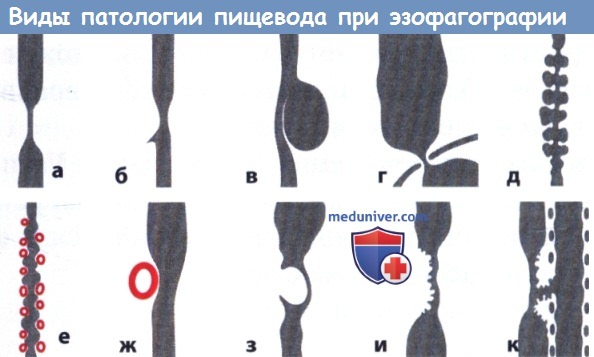 Виды врожденных заболеваний пищевода 