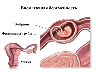 Возможна ли беременность после ампутации матки 