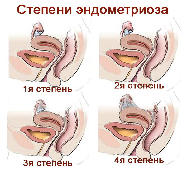 Все виды выделений после мecячных: признаки гинекологических заболеваний 