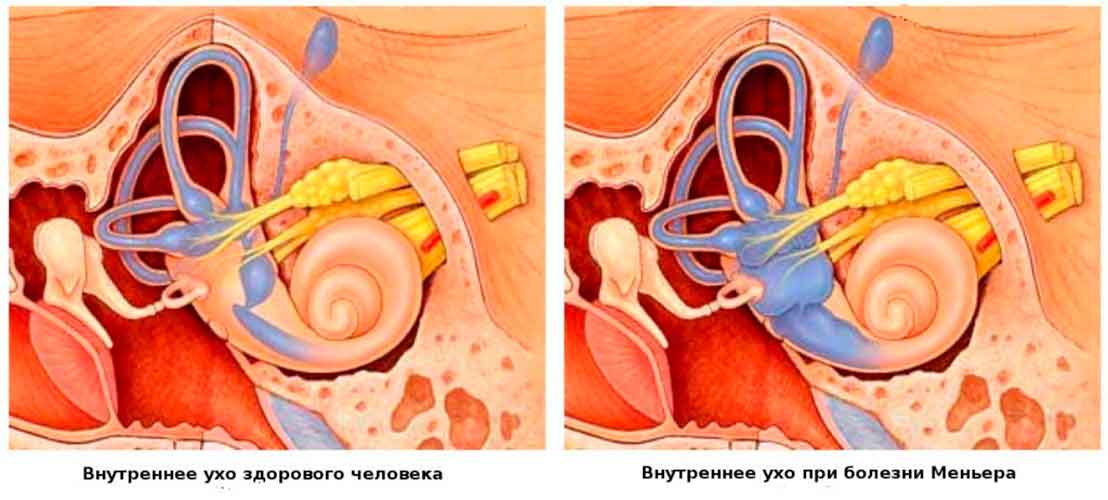 Болезнь Меньера 