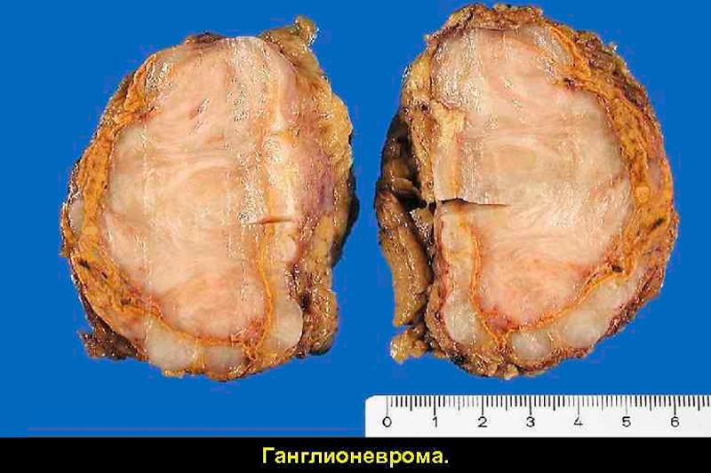 Что такое ганглиома? Виды, диагностика и методы лечения опухоли 