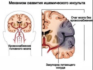 Ишемический инсульт головного мозга: прогноз для жизни и восстановления утраченных функций 