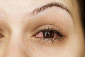 Красные глаза при ВСД: симптомы и лечение 