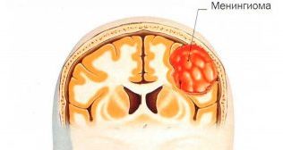 Менингиома головного мозга — прогноз жизни 