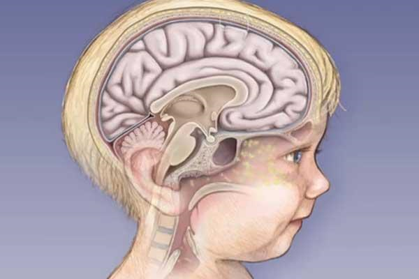 Менингит - симптомы у детей 