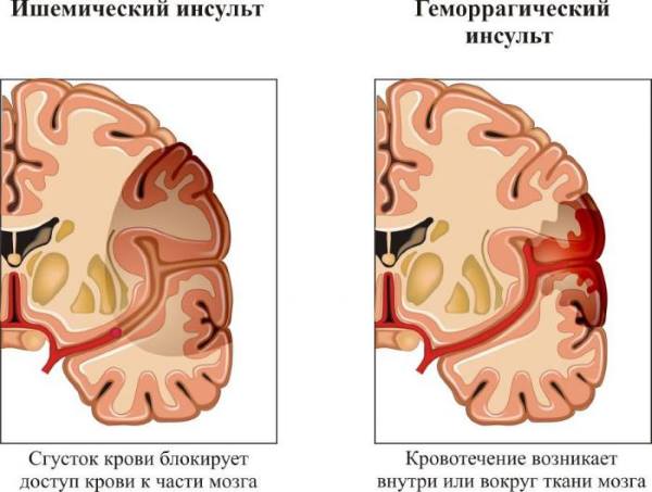 Методы восстановления речи после инсульта 