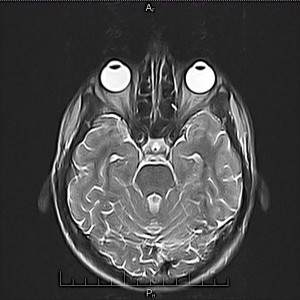 МРТ глазных орбит и зрительных нервов 