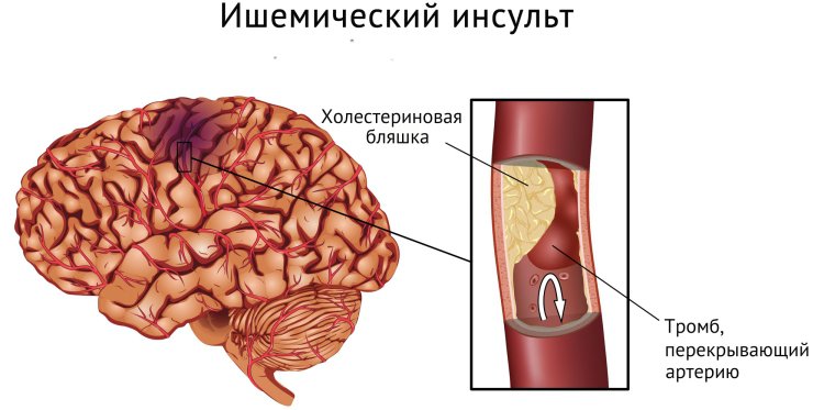 Обширный ишемический инсульт 