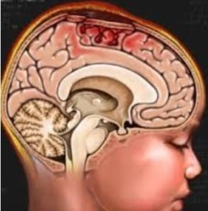 Отек головного мозга, как осложнение после инсульта 