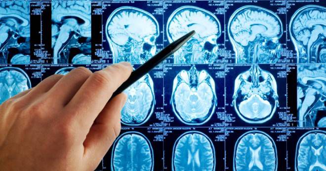 Отек мозга: причины и формы, симптомы, лечение, осложнения и прогноз 