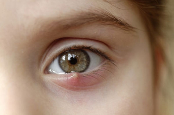 Почему болят глаза у ребенка 