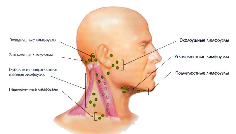 Почему воспаляются лимфоузлы на голове и как их лечить 