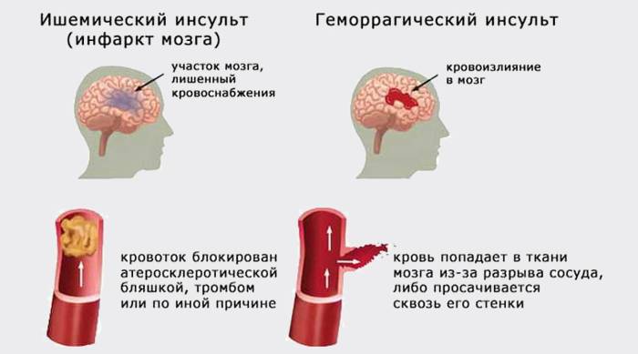 Шесть действенных способов, как улучшить мозговое кровообращение 