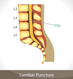 Спинномозговая пункция: когда проводят, ход процедуры, расшифровка, последствия 