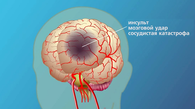 Упражнения после инсульта: для туловища, рук и координации 