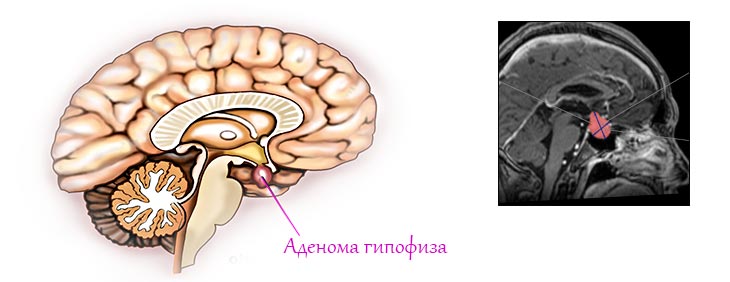 Аденома гипофиза 