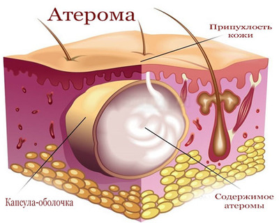 Атерома молочных желез 