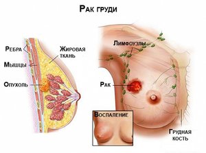 Болезни молочных желез 