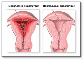 Чем опасна гиперплазия в менопаузе? 