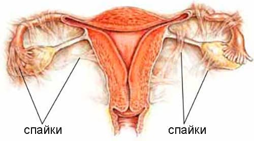 Чем опасно забеременеть со спайками в маточных трубах? 