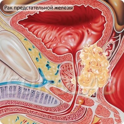 Четвертая стадия paка предстательной железы: методы, позволяющие продлить жизнь. 