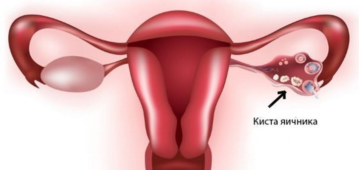 Что такое геморрагическая киста яичника: ее симптомы, причины появления, диагностика и лечение + отзывы женщин 