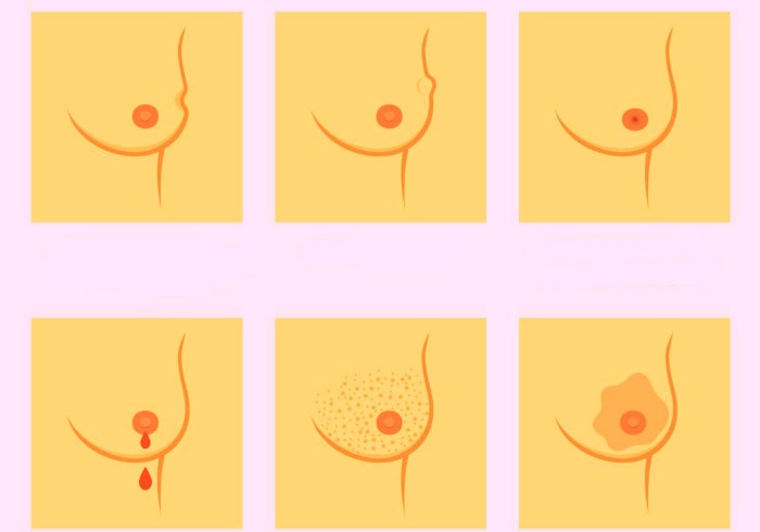 Что такое мастопатия у женщин и как ее лечить? 
