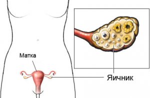 Два желтых тела в одном яичнике — что это значит? 