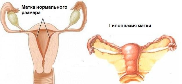 Какие проявления указывают на дефицит эстрогена? 