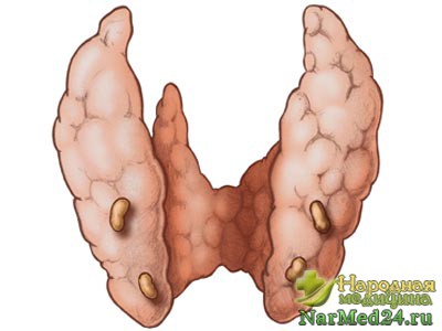 Как избавится от гиперпаратиреоза: лечение разновидностей недуга народными средствами 