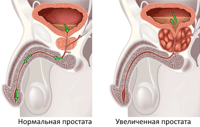 Как лечить аденому предстательной железы в домашних условиях 