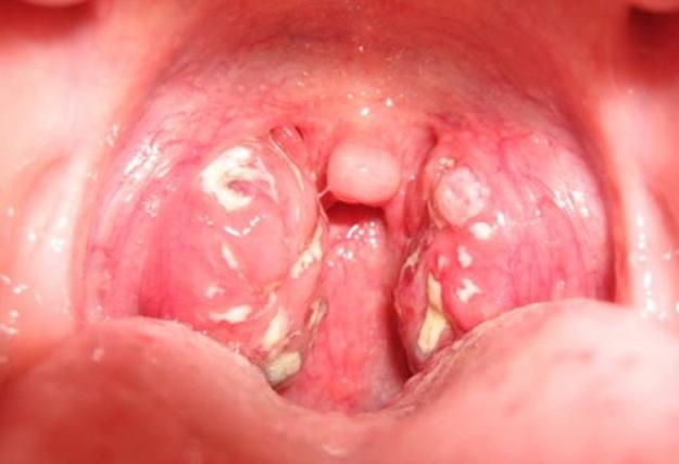 Как лечить казеозные пробки в горле? 