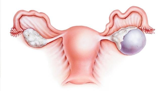 Как лечить кисту яичника без операции 