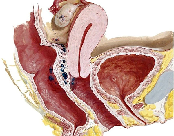 Как проявляется ретроцервикальный эндометриоз 