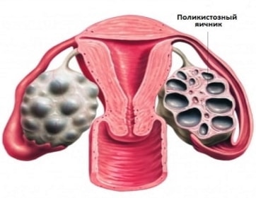 Какую диету следует соблюдать при поликистозе яичников? 