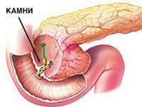 Камни в поджелудочной железе 