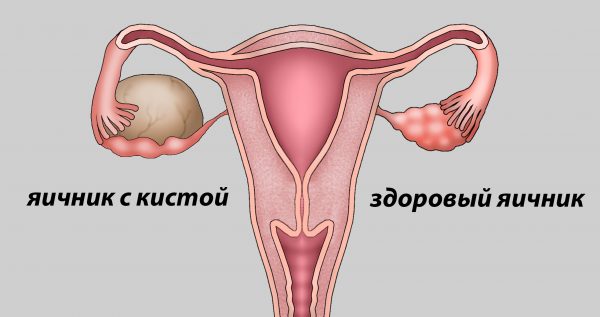 Кистозное образование яичников: причины патологии, методы лечения 