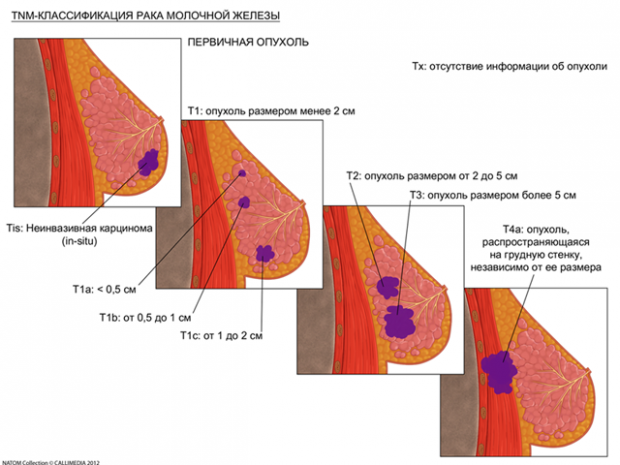 Классификация paка молочной железы 