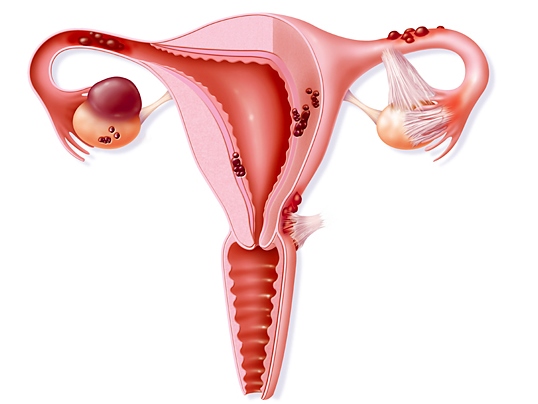 Коварное заболевание для молодой мамы — эндометриоз после родов 
