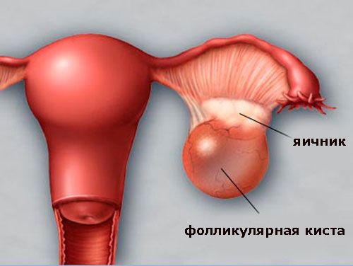 Кровотечение при кисте яичника 