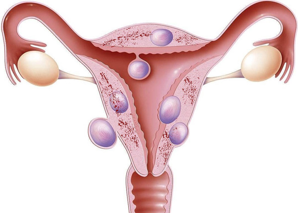 Миома в сочетании с эндометриозом 