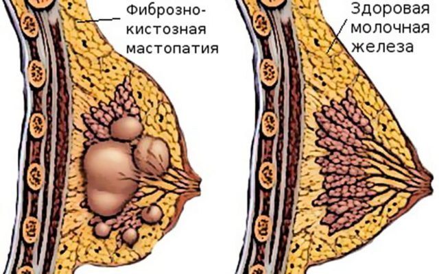 Можно ли делать массаж при мастопатии молочных желез? 