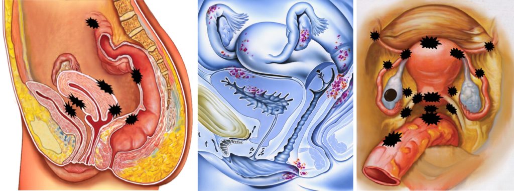 Можно ли забеременеть при эндометриозе яичника 