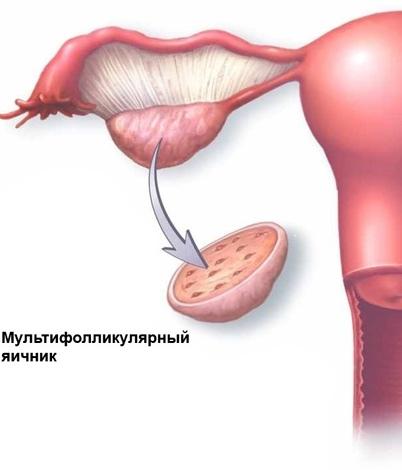 Мультифолликулярные яичники — лечение с применением различных методик 