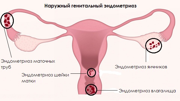Наружный эндометриоз 