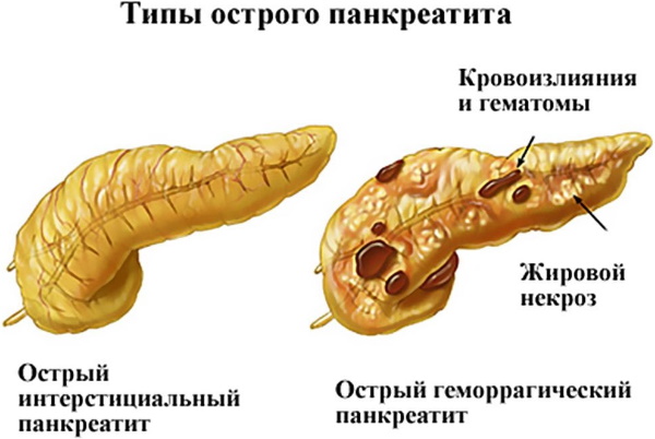 Обострение хронического панкреатита: терапия щадящей диетой 